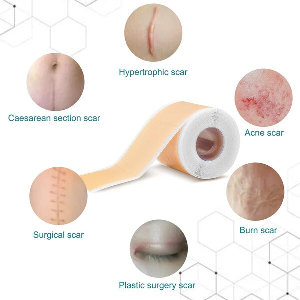 Silicone Scar Care Patch (Advanced Repair Edition) | Self-Adhesive | Reducing Pregnancy and Surgery Scars | Soft Silicone | Scar Care Support | ISMT260715A206