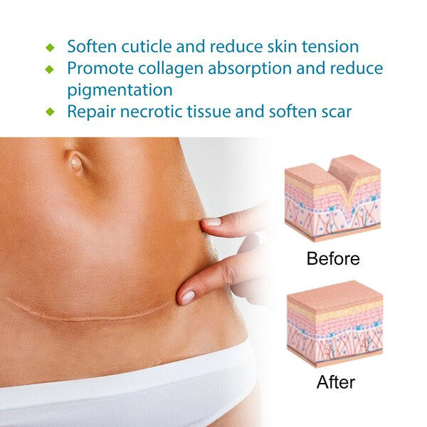 Silicone Scar Care Patch (Advanced Repair Edition) | Self-Adhesive | Reducing Pregnancy and Surgery Scars | Soft Silicone | Scar Care Support | ISMT260715A206