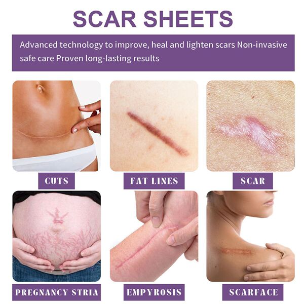 Silicone Scar Care Patch (Advanced Repair Edition) | Self-Adhesive | Reducing Pregnancy and Surgery Scars | Soft Silicone | Scar Care Support | ISMT260715A206