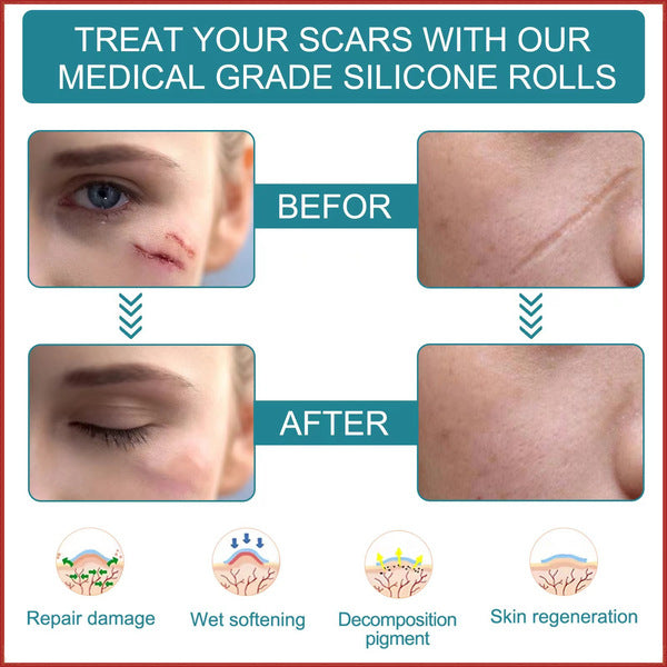 Silicone Scar Care Patch (Advanced Repair Edition) | Self-Adhesive | Reducing Pregnancy and Surgery Scars | Soft Silicone | Scar Care Support | ISMT260715A206